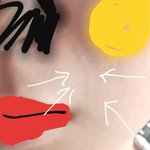 [조언부탁해] <b>팔자</b>주름 깊게 파였는데 어떡해야 함(사진ㅇ)