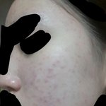 [댓글부탁해] 여드름 피부 진짜어떡해(사진○)
