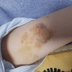 [방탈죄송] (+추가글)동생이 회사<b>상무</b>에게 성추행을 당했습니다 멍도들었네요...