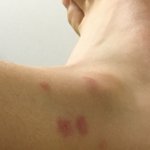 얘들아 나 모기 물린거 좀 심하지안ㅍ음?(약혐