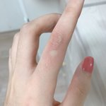[댓글부탁해] 원래 고양이한테 긁히면 이렇게 부어오르나?