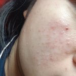 [드루와] 피부 거하게 뒤집어졌다가 4개월만에 거의 완벽복구했어