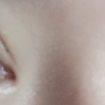 쌍수 재수술했는데