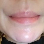 [조언구해요] 밀라노 의원 필러 부작용으로 미칠 것 같아요.. 도와주세요...