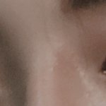 (옆모습 추가)코수술 6<b>달차</b> 티 많이나나요?ㅜㅡㄴ