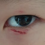 [방탈죄송요] 상대방아이가 저희아이눈에다스마트 폰을던져서 다쳤고...