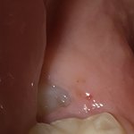 [이것좀봐줘] 이거 <b>사랑니야</b>?