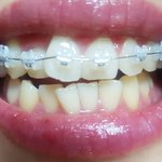 6개월간 교정변화