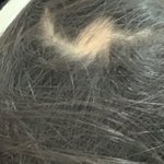 [조언부탁해] 얘들아 나 <b>탈모</b> 너무 심각해