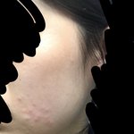 [댓글부탁해] 이거 여드름이야 <b>모낭염</b>이야?