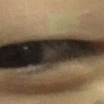 나 쌍수<b>전후</b> 대박임 ..