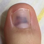 사진 ㅇ) 나 <b>발가락</b> 왜 이런지 알려줄 사람.,?