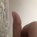 [조언부탁해] 나 <b>엄지</b>손가락 살너무뜯엇어