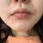 이거 무슨 <b>피부병</b>인지 아는사람 ㅠㅠ