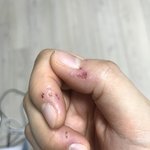 (약혐) 나 손 뜯는거심한지 좀 봐주라 ㅜㅜ