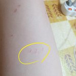 허벅지에 고양이 <b>발톱</b> 자국