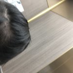나 16살인데 탈모 <b>개심</b>하지 않냐 ㅜㅜ