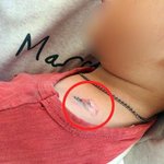 아파트서 던진 담배꽁초에 3살배기 화상