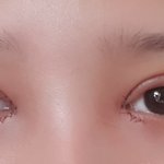 [댓글부탁해] 댓글좀 ㅠㅠ눈매교정 앞트임 <b>매몰</b> 2일차 어때???진짜 ㅠㅠ꼭...