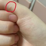 [댓글부탁해] 베인 <b>상처</b>가 붓기도 해??