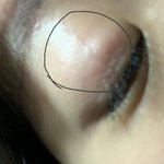 약혐) 얘들아 나 <b>눈꺼풀</b> 안쪽?에 뭐 났는데 뭔지 아는 사람ㅠㅠㅠ