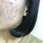 혐주의)피부과 여드름 <b>압출</b>해본사람