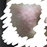 [댓글부탁해] [<b>현재</b> 사진 추가]여드름 없애는법좀 ㅈㅂ ㅠㅠ