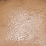 [조언부탁해] <b>이마</b>피부어떡해...도와줘(극혐주의)