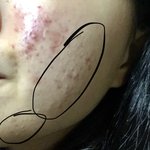 여드름 피부 땜에 맨날 움 (사진 약혐)