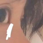고1 코수술 에바 ??