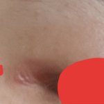트임성형부작용 맞아요?