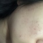 [드루와] 피부과 다닌 후기