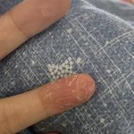 하 나 습진 개심해(사진있음 약<b>약약</b>혐)