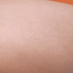 [19] 허벅지 튼살 어떡해