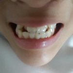 나 이빨 총체적<b>난국</b>이라 교정못함