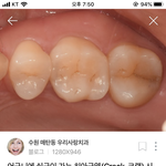[댓글부탁해] 얘들아 나 <b>치아</b> 이거 충치인가..?