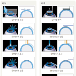 라식과 <b>라섹</b>의 장단점