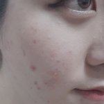 약혐) 이런 여드름 어케해야 없어지는 <b>지아</b>는 사람..제발