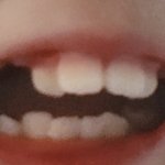 내 교정 <b>전후</b>가 ㄹㅇ 레전드임 ㅋㅋㅋㅋ