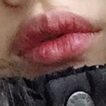 입꼬리 <b>시술</b> ㄱ?ㄴ?