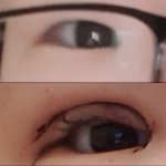 [댓글부탁해] 혐짤 주의) 절개 쌍수 후기 풀게..