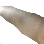 내 튼살 <b>셀룰라이트</b>..