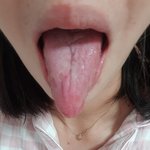 혀 갈라지신분 계신가요?*사진혐주의*