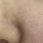 모공이 너무 넓어 ㅜㅜ 혐혐