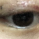 쌍수 <b>실밥</b> 나왔어 ㅠㅠ