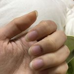 [댓글부탁해] 내 <b>손톱</b> 왜 이럴까..?(약혐주의))