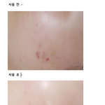 여드름, <b>민감</b>피부관련 꿀팁!!