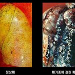 [19] 3년 <b>흡연자</b>의 폐.jpg