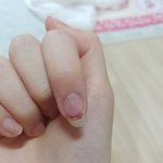 혐주의) <b>손톱</b> 요래됐을때 어떡해야됨ㅜㅜㅜㅜㅜ