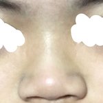 [댓글부탁해] 코 성형수술 응원해줘
